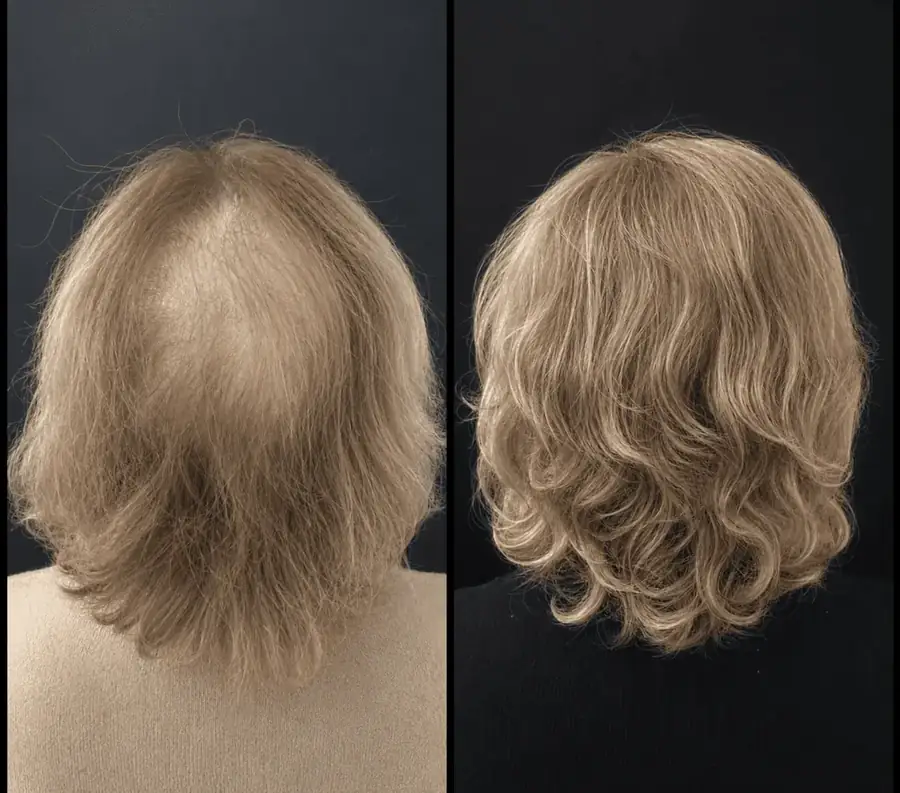 Antes e depois: Densidade no vértex