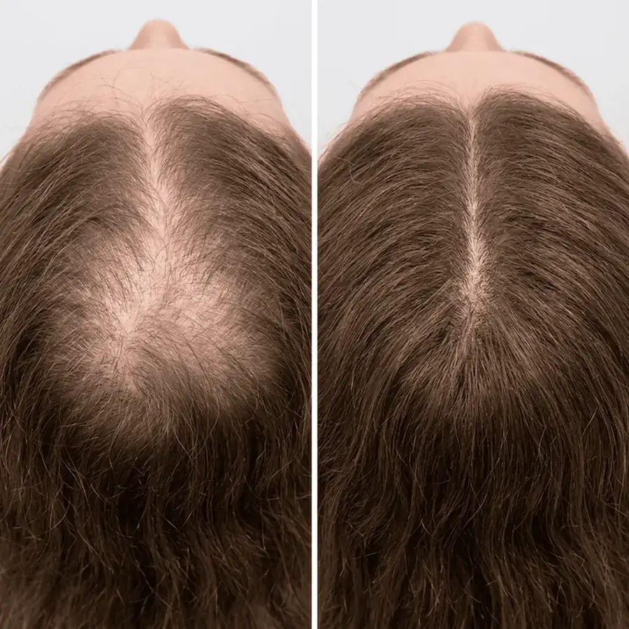 Antes e depois: Linha central