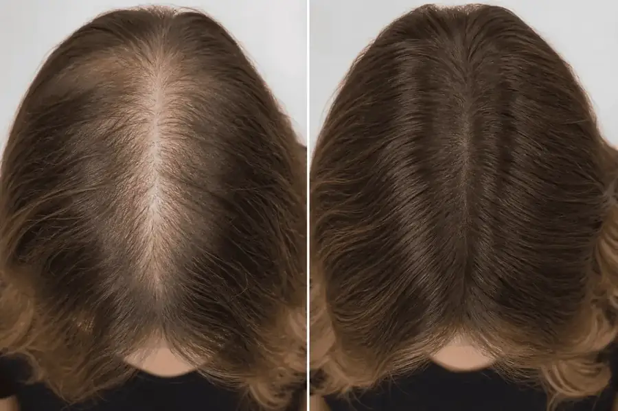 Antes e depois: Top frontal