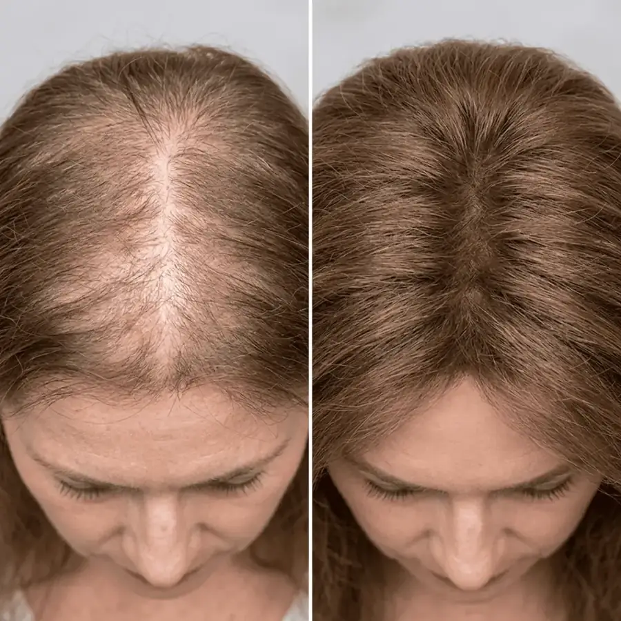 Antes e depois: Pós-menopausa